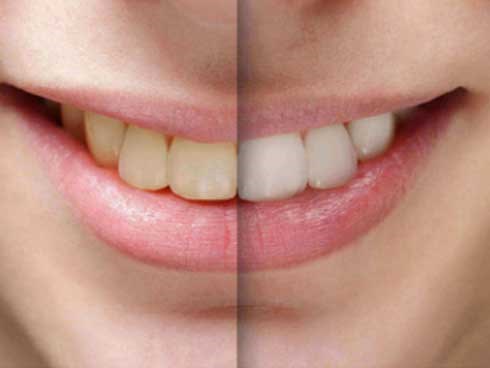 Bị sâu răng và răng ố vàng dù không ăn uống đồ ăn có axit, người đàn ông giật mình khi bác sĩ phát hiện mắc bệnh ung thư dạ dày