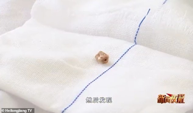 Sụt sịt 3 tháng liền, chàng trai đi khám thì phát hiện ra chiếc răng... 20 năm tuổi trong lỗ mũi-1