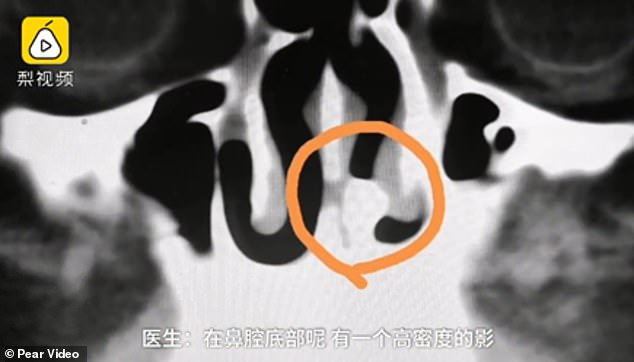 Sụt sịt 3 tháng liền, chàng trai đi khám thì phát hiện ra chiếc răng... 20 năm tuổi trong lỗ mũi-3