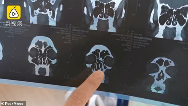 Sụt sịt 3 tháng liền, chàng trai đi khám thì phát hiện ra chiếc răng... 20 năm tuổi trong lỗ mũi-5