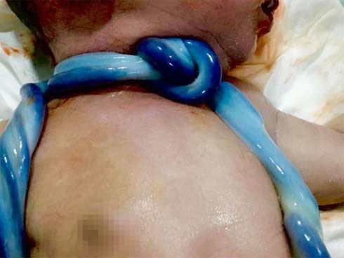 Hơn 40 tuần mới có dấu hiệu đòi ra, vừa chào đời, bé trai đã 