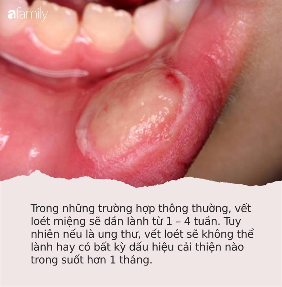 Đừng coi thường 4 dấu hiệu này khi loét miệng bởi có thể đó là bằng chứng cảnh báo ung thư đang phát triển trong cơ thể bạn-1