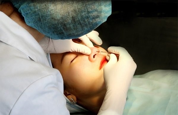 Đừng để thẩm mỹ nâng mũi trở thành quyết định sai lầm vì không biết những điều này-4