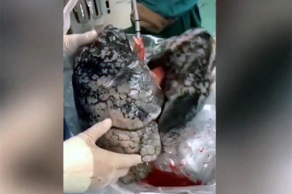 Video bộ phổi đen sì của người nghiện thuốc lá-2