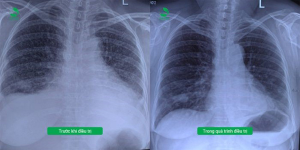 BV Thu Cúc kiểm soát thành công khối u phổi ác tính-2