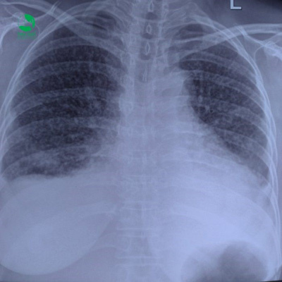 BV Thu Cúc kiểm soát thành công khối u phổi ác tính-1