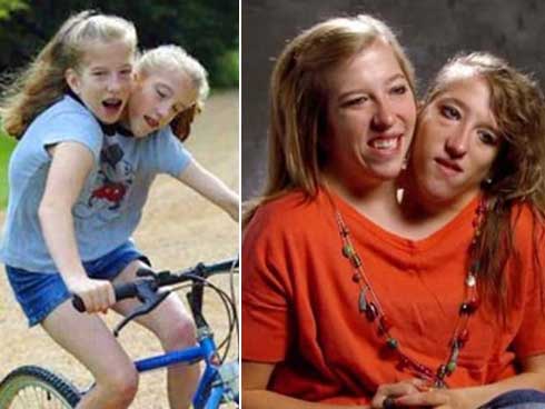 Câu chuyện cặp chị em song sinh với cơ thể dính liền từ chối phẫu thuật tách đôi, nguyện cùng nhau sống trong 1 thân xác-6