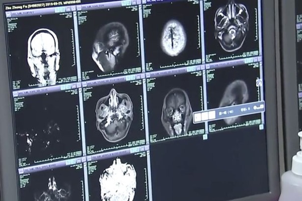 Bác sĩ phát hiện 700 con sán dây làm tổ, gây tổn thương trong não, ngực và phổi của một người đàn ông ăn thịt lợn chưa chín-1