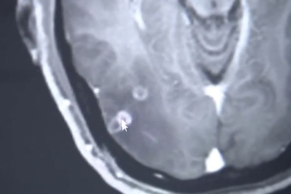 Bác sĩ phát hiện 700 con sán dây làm tổ, gây tổn thương trong não, ngực và phổi của một người đàn ông ăn thịt lợn chưa chín-2