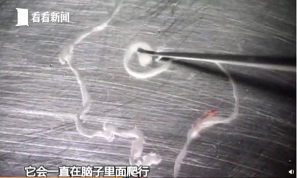 Bác sĩ phát hiện 700 con sán dây làm tổ, gây tổn thương trong não, ngực và phổi của một người đàn ông ăn thịt lợn chưa chín-6