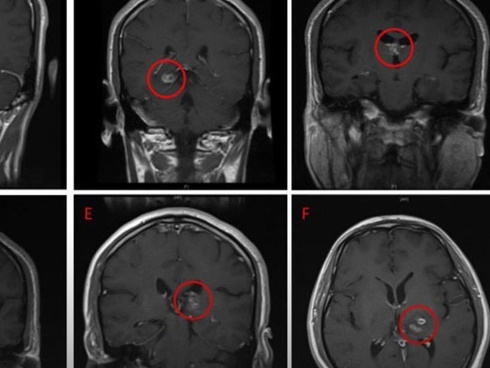Kinh hãi hình ảnh sán dây bò dài cả mét kéo ra từ bụng bệnh nhân, hãy cảnh giác khi ăn những món khoái khẩu này!-4