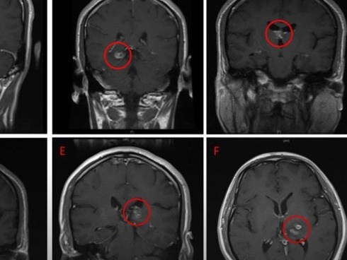 Bác sĩ phát hiện 700 con sán dây