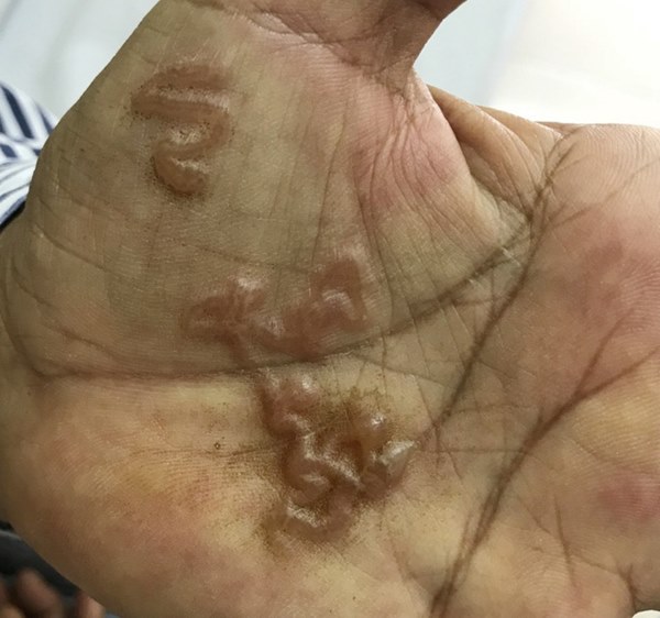 Loại giun sán khiến nhiều người dân ở Khánh Hòa phải nhập viện thực sự đáng sợ thế nào?-1