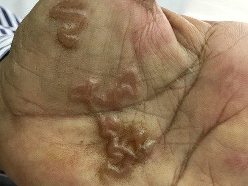 Loại giun sán khiến nhiều người dân ở Khánh Hòa phải nhập viện thực sự đáng sợ thế nào?