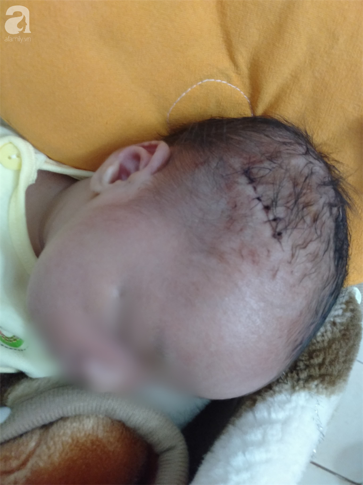Nóng: Bệnh viện mổ bắt con khiến bé trai sơ sinh bị rách đầu, khâu 6 mũi, có biểu hiện sốt, co giật-2
