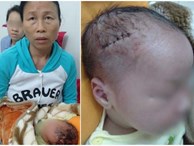 Nóng: Bệnh viện mổ bắt con khiến bé trai sơ sinh bị rách đầu, khâu 6 mũi, có biểu hiện sốt, co giật