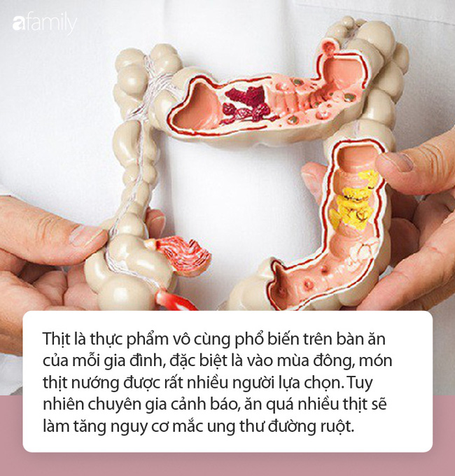 Chuyên gia cảnh báo: Ăn quá nhiều 3 loại thịt này, rất dễ gây ung thư đường ruột-1