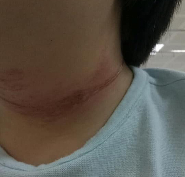 Sự thật về thông tin 2 cháu bé ngồi sau xe mẹ ngã gãy chân vì bị thanh niên thòng dây vào cổ-2