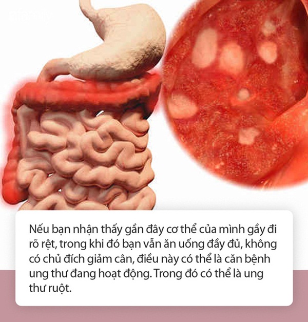 Nếu cơ thể có 5 biểu hiện này, chứng tỏ tế bào ung thư đã xâm lấn đến đường ruột-1