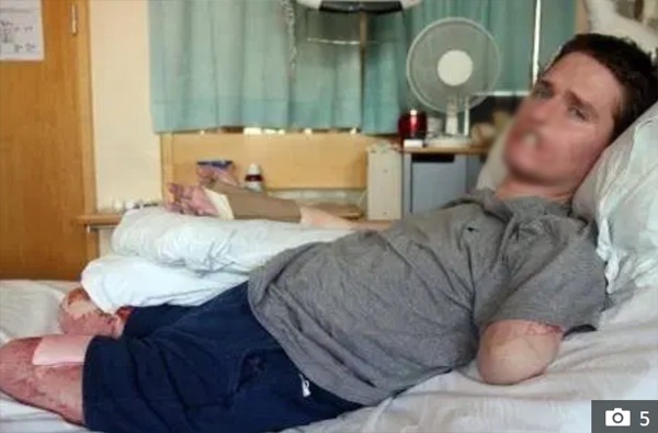 Người đàn ông phải cắt bỏ môi và tứ chi vì nghĩ mình bị cảm cúm thông thường-2