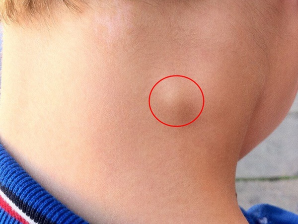 Thấy 3 dấu hiệu đột ngột, bạn nên cẩn thận vì nguy cơ bệnh ung thư giai đoạn cuối rất cao-3