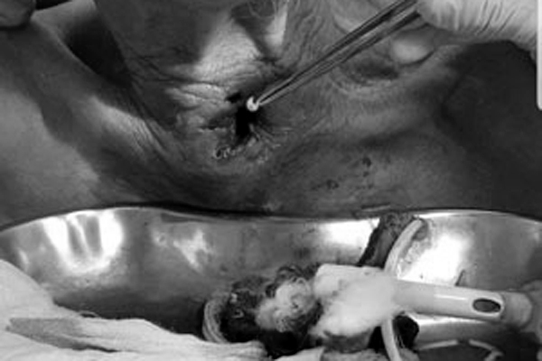 Bác sĩ rùng mình gắp 30 con giòi trong cổ bệnh nhân-1