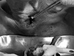 Hàng chục con giòi làm tổ trong tai người đàn ông ở Quảng Trị-3