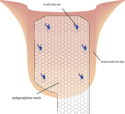 Vinmec - điều trị sa sàn chậu bằng kỹ thuật nội soi hiện đại hàng đầu-1