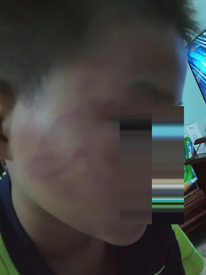 Phụ huynh tố thầy giáo đánh học sinh bầm tím mặt, nhà trường nói gì?-1