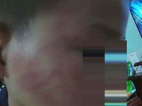 Phụ huynh tố thầy giáo đánh học sinh bầm tím mặt, nhà trường nói gì?