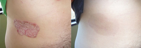 Giải pháp kiểm soát vảy nến thể mảng hiệu quả-2