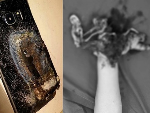 Vừa dùng vừa sạc điện thoại, nam thanh niên 16 tuổi nát tay phải cắt cụt