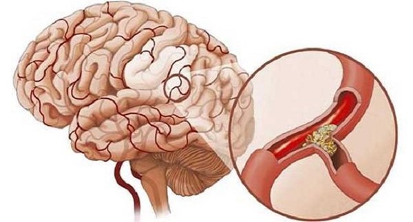 3 triệu chứng khó chịu khi ngủ cảnh báo bệnh nhồi máu não-1