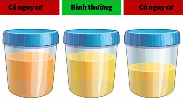 Nếu có 5 dấu hiệu này, nên đi khám thận ngay kẻo bên trong chứa đầy sỏi mà không biết-2