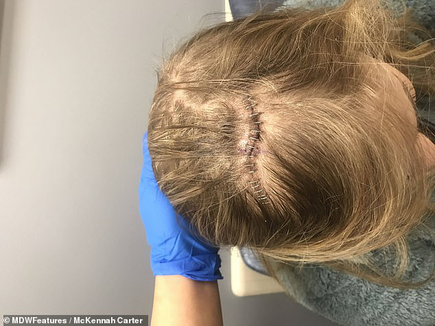 Đau nửa đầu kéo dài tưởng chỉ bị cúm, cô gái trẻ ngã ngửa khi biết mình đã bị ung thư ăn cả vào gan, phổi, xương...-5