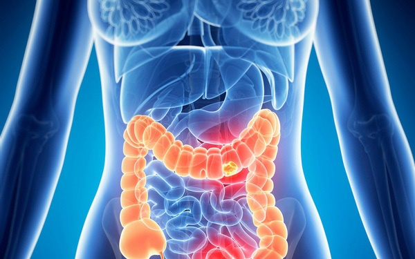 5 loại thực phẩm càng ăn nhiều càng dễ mắc ung thư ruột-1