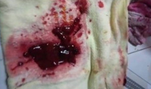 Đưa con trai bị nôn ra máu đi bệnh viện, cả nhà rùng mình khi nhìn thấy thứ này được gắp ra khỏi cơ thể bé-2