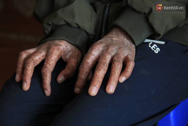 Nghẹn lòng cậu bé bị bệnh mặt quỷ”: Nó không dám đi học, bạn bè thấy thì chạy hết, cứ lủi thủi một mình như thế từ bé đến giờ”-7