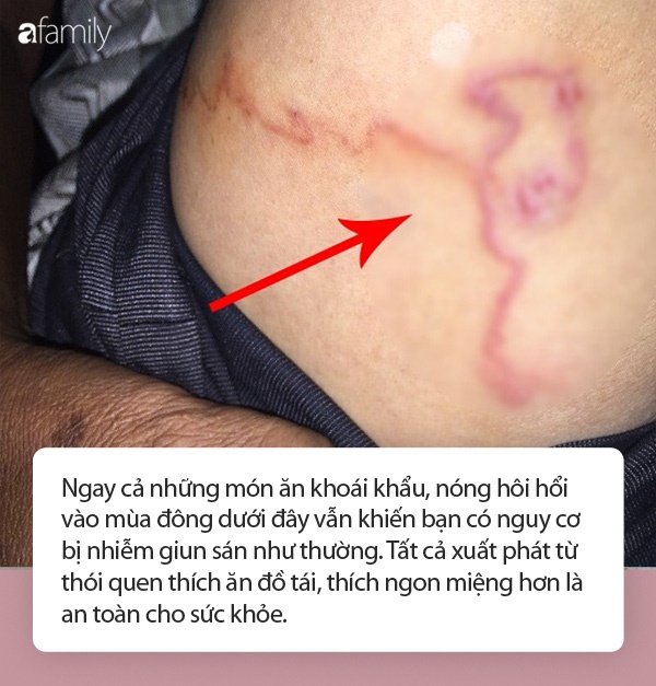 Những món khoái khẩu được nhiều người yêu thích khi gió lạnh nhưng đồng thời lại tiếp tay cho giun sán chui vào làm tổ trong cơ thể-1