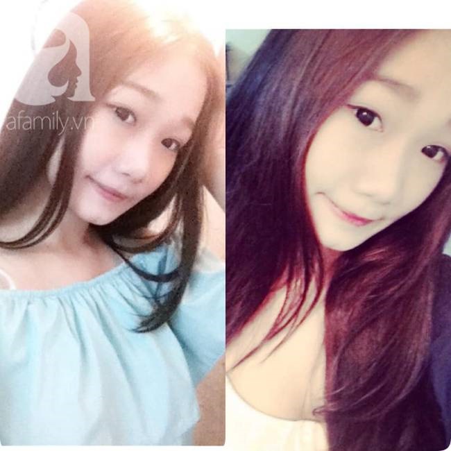 Câu chuyện kinh hãi” của cô gái nâng mũi 4 lần đến mức hết sạch sụn tai, từng trầm cảm, muốn chết vì phẫu thuật hỏng-1