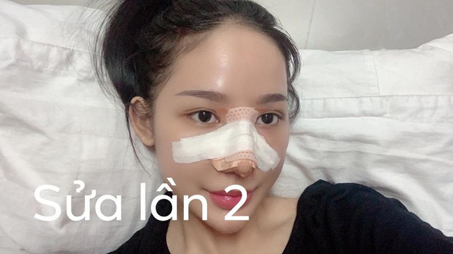 Câu chuyện kinh hãi” của cô gái nâng mũi 4 lần đến mức hết sạch sụn tai, từng trầm cảm, muốn chết vì phẫu thuật hỏng-3