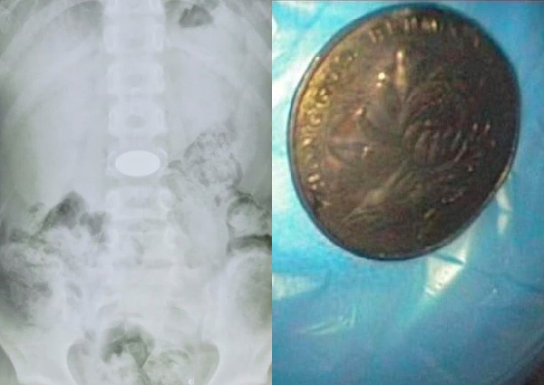 Không muốn làm bài tập về nhà, cậu bé 8 tuổi nuốt đồng xu vào bụng nhưng cái kết là điều cậu bé không ngờ đến-1