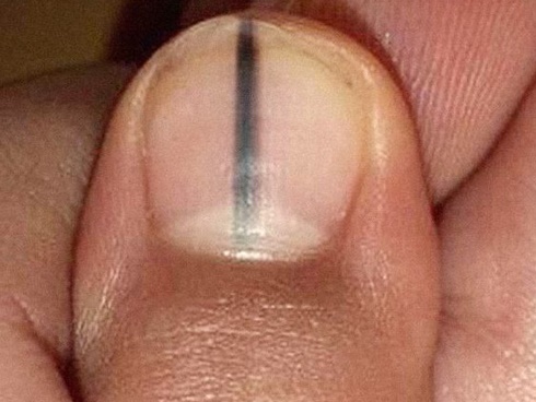 Cách đơn giản ngăn ngừa ung thư đại trực tràng ngay tại nhà-4