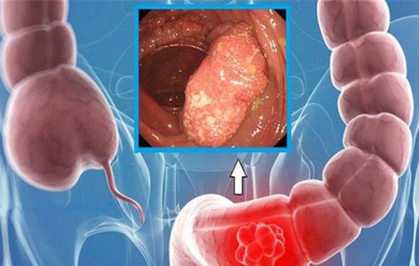 Cách đơn giản ngăn ngừa ung thư đại trực tràng ngay tại nhà-2