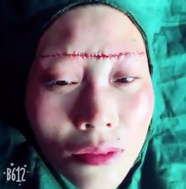 Rùng rợn những hình ảnh nâng chân mày, nâng mũi sởn gai ốc, người phụ nữ sau phẫu thuật đưa ra lời khuyên chân thành đến chị em ham làm đẹp-2