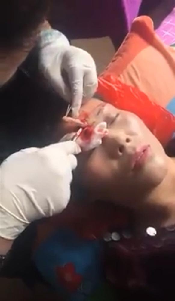 Rùng rợn những hình ảnh nâng chân mày, nâng mũi sởn gai ốc, người phụ nữ sau phẫu thuật đưa ra lời khuyên chân thành đến chị em ham làm đẹp-3