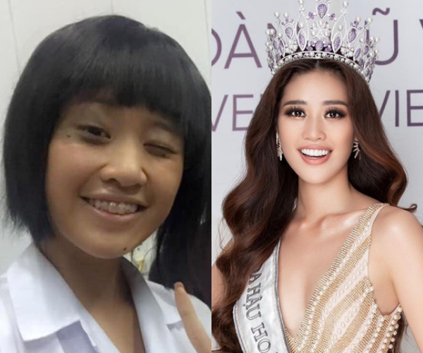 Loạt sao chứng minh sức mạnh vi diệu của niềng răng và thời điểm vàng để bạn cứu vãn” nhan sắc nhờ chỉnh nha-1