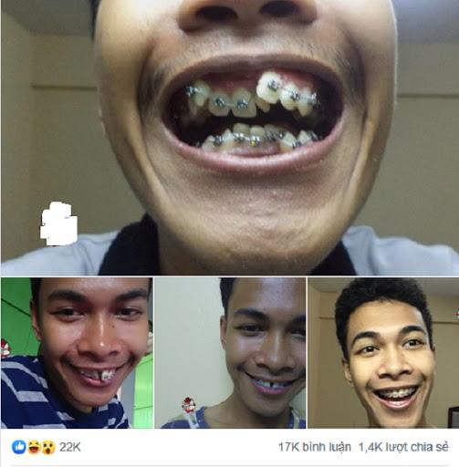 Loạt sao chứng minh sức mạnh vi diệu của niềng răng và thời điểm vàng để bạn cứu vãn” nhan sắc nhờ chỉnh nha-5