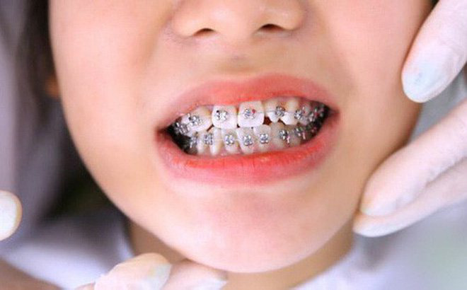 Loạt sao chứng minh sức mạnh vi diệu của niềng răng và thời điểm vàng để bạn cứu vãn” nhan sắc nhờ chỉnh nha-6