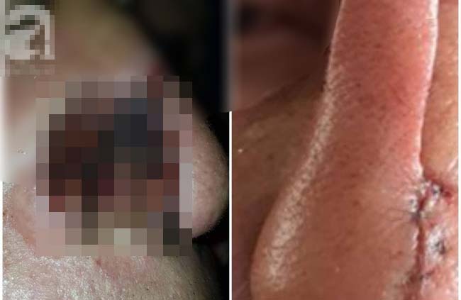 Kinh hoàng cháu nhậu say cắn mũi bác rồi nuốt luôn vào bụng-1